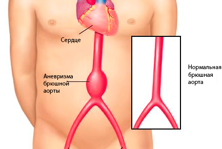 аневризма брюшной аорты, аневризма абдоминальной аорты, аневризма аорты